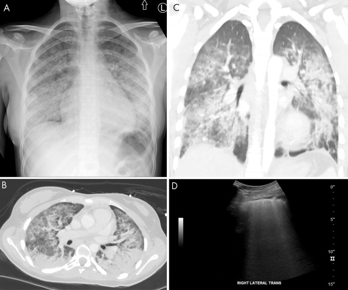 Vaping lung injury on lung US. A, Anteroposterior chest radiograph demonstrates nonspecific bilateral interstitial and consolidative pulmonary opacity in a 17-year-old adolescent girl with a vaping-induced lung injury. B, Axial and C, coronal CT images demonstrate diffuse bilateral consolidation, interstitial thickening, and ground-glass opacity. D, Lung US demonstrates loss of A-lines with confluent B-line artifacts better appreciated on the cine clip (Movie 4) Trans = transverse.