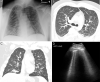 Pulmonary edema on lung US. A, Anteroposterior chest radiograph shows nonspecific prominent interstitial markings bilaterally in a 27-year-old man with pulmonary edema. B, Axial and C, coronal CT images show marked bilateral septal thickening, scattered consolidation, and ground-glass opacity. D, Lung US shows B-line artifacts arising from the pleural line and loss of A-lines. Movie 3 shows B-line artifacts in this same patient.