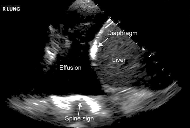 Pleural effusion on lung US. Lung US image of a patient with a moderate-sized pleural effusion. The acoustic window created by the effusion allows visualization of the spine (spine sign), as can be seen in this image. Normally, the vertebral bodies are not apparent on US.