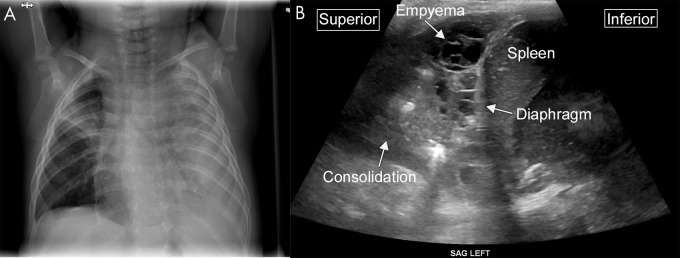 Complex collection on lung US. A, Anteroposterior chest radiograph demonstrates near complete opacification of the left hemithorax, with loculated pleural fluid tracking along the left lateral chest wall in an 8-month-old male infant. In addition, a focal consolidation is present in the right upper lobe. B, Sagittal US image from the same patient shows consolidation within the lung and a multiseptated complex pleural fluid collection consistent with empyema.