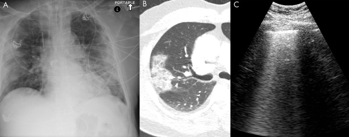 COVID-19 infection on lung US. A, Anteroposterior chest radiograph, B, axial chest CT image, and C, lung US image from the same 74-year-old man, who tested positive for COVID-19 5 days prior to imaging. The chest radiograph shows bilateral peripheral opacity, which presents with a ground-glass appearance on the chest CT image. Lung US imaging in this patient demonstrated numerous B-lines throughout the parenchyma which were diffusely confluent in some sections. These are better seen in a cine clip (Movie 9). A small consolidation in a patient with COVID-19 is shown in Movie 10.