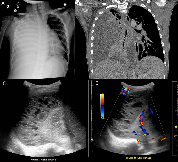 Empyema on lung US. A, Anteroposterior chest radiograph and B, coronal chest CT image show a large, right-sided empyema occupying the pleural space with associated compression of the pulmonary parenchyma in a 9-year-old boy. Lung US C, grayscale and D, Doppler images demonstrate a multiloculated complex-appearing fluid collection in the pleural space with septations and internal debris without internal color flow.