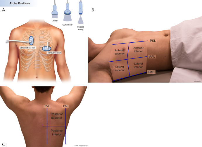 Process of performing lung US. A, Illustration demonstrates basic longitudinal and transverse probe orientations. B, C, A complete lung US examination includes transverse and longitudinal scans through the anterior, lateral, and posterior lungs. AAL = anterior axillary line, PAL = posterior axillary line, PSL = parasternal line, PVL = paravertebral line. (Reprinted, with permission, from University of Rochester, Rochester, New York © 2021; medical illustration by Gwen Mack and Nadezhda D. Kiriyak and photographs by Sarah Klingenberger).