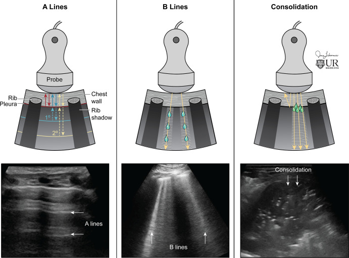 Physics of lung US. (Left) Ultrasound waves reflected at the pleural line creating A-line reverberation artifacts. (Center) As the interstitium thickens, the artifact pattern changes, with B-line artifacts obliterating A-lines. B-lines are hyperechoic vertical artifacts arising from the pleural line extending to the bottom of the field of view. (Right) Consolidation is directly penetrated by US, resulting in visualization without artifact if the consolidation is touching the pleural line. (Reprinted, with permission, from University of Rochester, Rochester, New York © 2021; medical illustration by Jane Lichorowic).