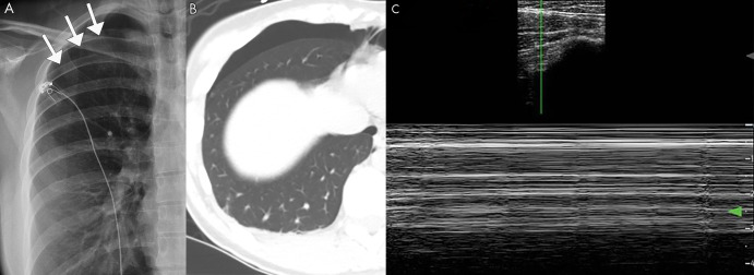 Pneumothorax on lung US. A, Posteroanterior chest radiograph and B, axial CT image of a spontaneous pneumothorax in a 26-year-old patient. C, M-mode US image shows the barcode sign, in which the smooth horizontal lines corresponding to the stationary chest wall are uninterrupted owing to lack of lung sliding, which is diagnostic for pneumothorax. Cine clips show absent lung sliding in the right lung (Movie 5) and the normal lung sliding in the left lung (Movie 6), which cannot be appreciated on still imaging. Arrows indicate location of the pleura in the setting of a pneumothorax.