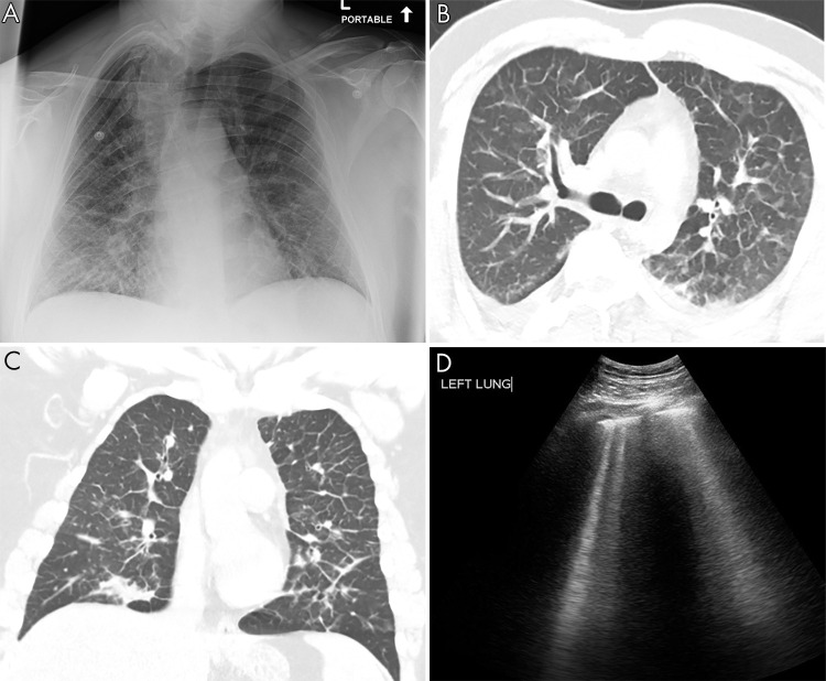 Pulmonary edema on lung US. A, Anteroposterior chest radiograph shows nonspecific prominent interstitial markings bilaterally in a 27-year-old man with pulmonary edema. B, Axial and C, coronal CT images show marked bilateral septal thickening, scattered consolidation, and ground-glass opacity. D, Lung US shows B-line artifacts arising from the pleural line and loss of A-lines. Movie 3 shows B-line artifacts in this same patient.