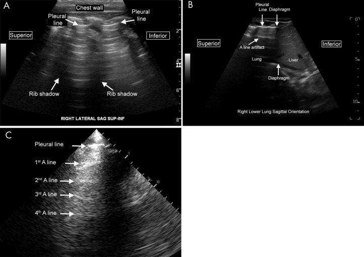 Normal lung US anatomy. A, Labeled US image of normal lung in a pediatric patient (scanning performed in the sagittal orientation with a curvilinear abdominal probe). The pleural line is the labeled hyperechoic line that represents the junction of the visceral and the parietal pleura. The A-line artifacts are clearly visualized as horizontal reverberation artifacts of the hyperechoic pleural line. The rib shadows separate the intercostal spaces. B, Labeled US image of normal lung in a neonate (scanning performed in the sagittal orientation at the lower lung). The interface between the liver and lung is clearly visualized. C, Labeled lung image from a lower-end ultrasound machine with a suboptimal acoustic window. Even on such limited examinations, normal A-line artifact can often still be appreciated on careful examination, as seen here. Cine clips show normal lung sliding (Movie 1) and absent lung sliding (Movie 2).