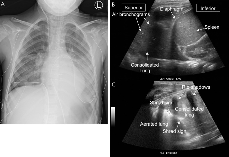 Pneumonia on lung US. A, Anteroposterior chest radiograph and B, C, US images from a 6-year-old patient with pneumonia. The lower lung on US appears similar in appearance to the liver, representing so-called hepatization of the pulmonary parenchyma consistent with consolidation. B, The hyperechoic foci within the consolidation are air bronchograms. C, The shred sign is the irregular hyperechoic line separating the consolidated and aerated lung. A sagittal cine clip (Movie 7) and a transverse cine clip (Movie 8) show more detail. LT = left, RLD = right lateral decubitus.