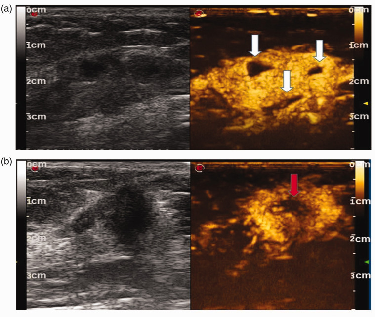 Combining contrast-enhanced ultrasound and blood cell analysis to ...