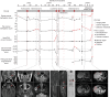 Figure 6. Longitudinal tracks for select LFS patients showing ctDNA signal, clinical information, and imaging data. LFS3—Left: coronal T2 (upper) and axial FLAIR (lower) MRI. Middle: coronal T1 (upper) and fat-suppressed axial T2 (lower) MRI. Right: fat-suppressed coronal T1 (upper) and fat-suppressed axial T2 MRI. LFS15—Left: coronal inversion recovery MRI. Middle: coronal inversion recovery MRI. Right: reformatted coronal diffusion-weighted MRI. LFS78—Left: fat-suppressed axial T1 MRI. Right: contrast-enhanced CT.