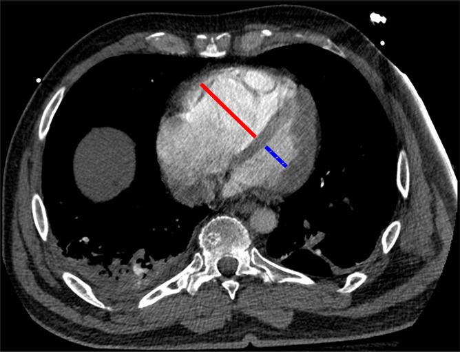 Examples of study- and image-level labels. (a) Central Pulmonary Embolism (PE): saddle embolus within the main, right, and left pulmonary arteries (arrow). (b) Right-sided PE and Left-sided PE: pulmonary emboli within the right interlobar, right lower lobe (arrow), and lingular pulmonary arteries (arrowhead). (c) Chronic PE: nonocclusive intraluminal web within the right lower lobe pulmonary artery (arrow). (d) True Filling Defect not PE: left lung malignancy invading the left main pulmonary artery. (e) Flow Artifact: an apparent filling defect within the left pulmonary artery, which is due to laminar flow of contrast media rather than PE (arrow). (f) RV/LV Ratio: < 1: normal RV (red line) to LV (blue line) ratio. (g) RV/LV Ratio: ≥ 1: evidence of right heart strain characterized by an elevated RV/LV ratio. (h) QA-motion: impaired image quality at the lung bases due to respiratory motion (arrows). (i) QA-contrast: insufficient opacification of the pulmonary arterial tree (arrow) to allow for the assessment of PE. LV = left ventricle, QA = quality assurance RV = right ventricle.