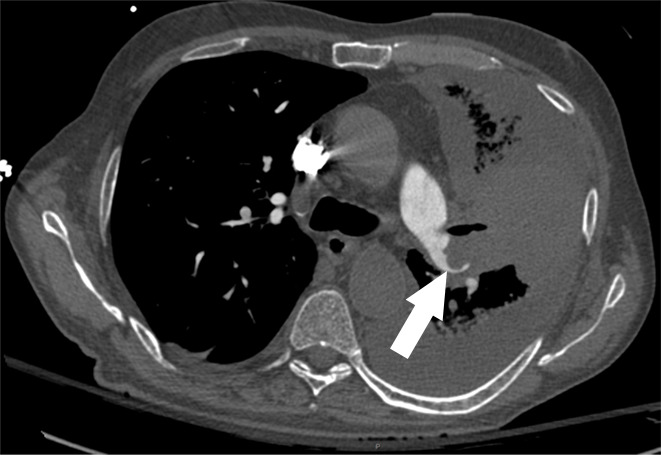 Examples of study- and image-level labels. (a) Central Pulmonary Embolism (PE): saddle embolus within the main, right, and left pulmonary arteries (arrow). (b) Right-sided PE and Left-sided PE: pulmonary emboli within the right interlobar, right lower lobe (arrow), and lingular pulmonary arteries (arrowhead). (c) Chronic PE: nonocclusive intraluminal web within the right lower lobe pulmonary artery (arrow). (d) True Filling Defect not PE: left lung malignancy invading the left main pulmonary artery. (e) Flow Artifact: an apparent filling defect within the left pulmonary artery, which is due to laminar flow of contrast media rather than PE (arrow). (f) RV/LV Ratio: < 1: normal RV (red line) to LV (blue line) ratio. (g) RV/LV Ratio: ≥ 1: evidence of right heart strain characterized by an elevated RV/LV ratio. (h) QA-motion: impaired image quality at the lung bases due to respiratory motion (arrows). (i) QA-contrast: insufficient opacification of the pulmonary arterial tree (arrow) to allow for the assessment of PE. LV = left ventricle, QA = quality assurance RV = right ventricle.