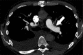 Examples of study- and image-level labels. (a) Central Pulmonary
Embolism (PE): saddle embolus within the main, right, and left pulmonary
arteries (arrow). (b) Right-sided PE and Left-sided PE: pulmonary emboli
within the right interlobar, right lower lobe (arrow), and lingular
pulmonary arteries (arrowhead). (c) Chronic PE: nonocclusive intraluminal
web within the right lower lobe pulmonary artery (arrow). (d) True Filling
Defect not PE: left lung malignancy invading the left main pulmonary artery.
(e) Flow Artifact: an apparent filling defect within the left pulmonary
artery, which is due to laminar flow of contrast media rather than PE
(arrow). (f) RV/LV Ratio: < 1: normal RV (red line) to LV (blue line)
ratio. (g) RV/LV Ratio: ≥ 1: evidence of right heart strain
characterized by an elevated RV/LV ratio. (h) QA-motion: impaired image
quality at the lung bases due to respiratory motion (arrows). (i)
QA-contrast: insufficient opacification of the pulmonary arterial tree
(arrow) to allow for the assessment of PE. LV = left ventricle, QA
= quality assurance RV = right ventricle.