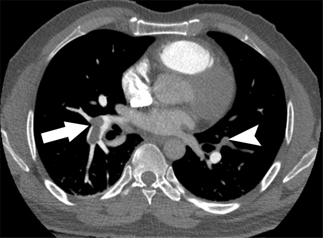 Examples of study- and image-level labels. (a) Central Pulmonary Embolism (PE): saddle embolus within the main, right, and left pulmonary arteries (arrow). (b) Right-sided PE and Left-sided PE: pulmonary emboli within the right interlobar, right lower lobe (arrow), and lingular pulmonary arteries (arrowhead). (c) Chronic PE: nonocclusive intraluminal web within the right lower lobe pulmonary artery (arrow). (d) True Filling Defect not PE: left lung malignancy invading the left main pulmonary artery. (e) Flow Artifact: an apparent filling defect within the left pulmonary artery, which is due to laminar flow of contrast media rather than PE (arrow). (f) RV/LV Ratio: < 1: normal RV (red line) to LV (blue line) ratio. (g) RV/LV Ratio: ≥ 1: evidence of right heart strain characterized by an elevated RV/LV ratio. (h) QA-motion: impaired image quality at the lung bases due to respiratory motion (arrows). (i) QA-contrast: insufficient opacification of the pulmonary arterial tree (arrow) to allow for the assessment of PE. LV = left ventricle, QA = quality assurance RV = right ventricle.