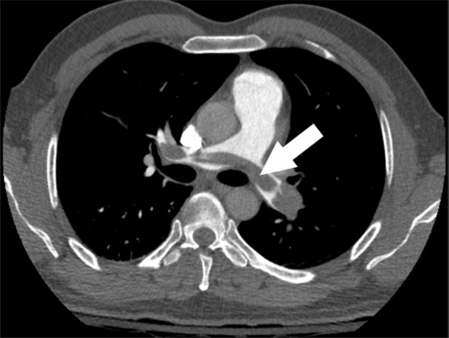 Examples of study- and image-level labels. (a) Central Pulmonary Embolism (PE): saddle embolus within the main, right, and left pulmonary arteries (arrow). (b) Right-sided PE and Left-sided PE: pulmonary emboli within the right interlobar, right lower lobe (arrow), and lingular pulmonary arteries (arrowhead). (c) Chronic PE: nonocclusive intraluminal web within the right lower lobe pulmonary artery (arrow). (d) True Filling Defect not PE: left lung malignancy invading the left main pulmonary artery. (e) Flow Artifact: an apparent filling defect within the left pulmonary artery, which is due to laminar flow of contrast media rather than PE (arrow). (f) RV/LV Ratio: < 1: normal RV (red line) to LV (blue line) ratio. (g) RV/LV Ratio: ≥ 1: evidence of right heart strain characterized by an elevated RV/LV ratio. (h) QA-motion: impaired image quality at the lung bases due to respiratory motion (arrows). (i) QA-contrast: insufficient opacification of the pulmonary arterial tree (arrow) to allow for the assessment of PE. LV = left ventricle, QA = quality assurance RV = right ventricle.