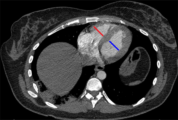 Examples of study- and image-level labels. (a) Central Pulmonary Embolism (PE): saddle embolus within the main, right, and left pulmonary arteries (arrow). (b) Right-sided PE and Left-sided PE: pulmonary emboli within the right interlobar, right lower lobe (arrow), and lingular pulmonary arteries (arrowhead). (c) Chronic PE: nonocclusive intraluminal web within the right lower lobe pulmonary artery (arrow). (d) True Filling Defect not PE: left lung malignancy invading the left main pulmonary artery. (e) Flow Artifact: an apparent filling defect within the left pulmonary artery, which is due to laminar flow of contrast media rather than PE (arrow). (f) RV/LV Ratio: < 1: normal RV (red line) to LV (blue line) ratio. (g) RV/LV Ratio: ≥ 1: evidence of right heart strain characterized by an elevated RV/LV ratio. (h) QA-motion: impaired image quality at the lung bases due to respiratory motion (arrows). (i) QA-contrast: insufficient opacification of the pulmonary arterial tree (arrow) to allow for the assessment of PE. LV = left ventricle, QA = quality assurance RV = right ventricle.