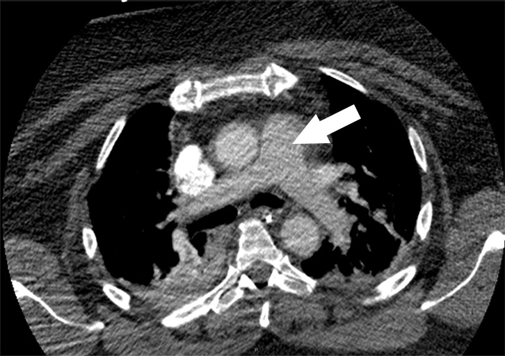 Examples of study- and image-level labels. (a) Central Pulmonary Embolism (PE): saddle embolus within the main, right, and left pulmonary arteries (arrow). (b) Right-sided PE and Left-sided PE: pulmonary emboli within the right interlobar, right lower lobe (arrow), and lingular pulmonary arteries (arrowhead). (c) Chronic PE: nonocclusive intraluminal web within the right lower lobe pulmonary artery (arrow). (d) True Filling Defect not PE: left lung malignancy invading the left main pulmonary artery. (e) Flow Artifact: an apparent filling defect within the left pulmonary artery, which is due to laminar flow of contrast media rather than PE (arrow). (f) RV/LV Ratio: < 1: normal RV (red line) to LV (blue line) ratio. (g) RV/LV Ratio: ≥ 1: evidence of right heart strain characterized by an elevated RV/LV ratio. (h) QA-motion: impaired image quality at the lung bases due to respiratory motion (arrows). (i) QA-contrast: insufficient opacification of the pulmonary arterial tree (arrow) to allow for the assessment of PE. LV = left ventricle, QA = quality assurance RV = right ventricle.