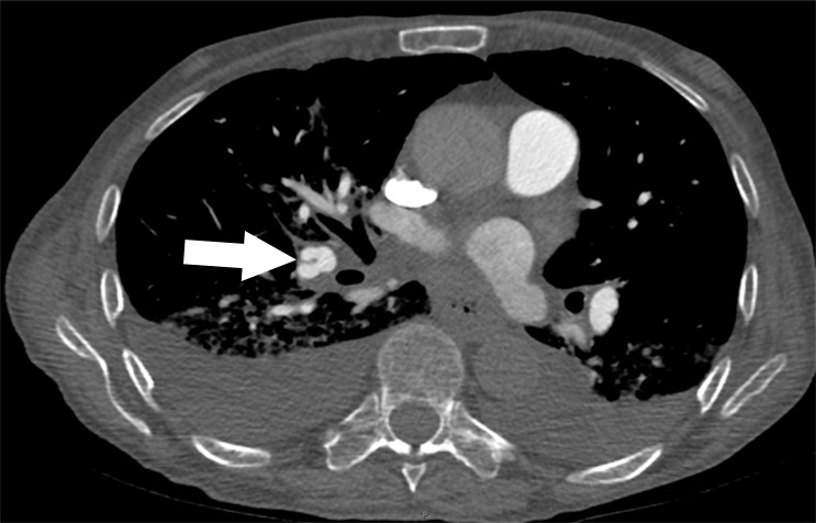 Examples of study- and image-level labels. (a) Central Pulmonary Embolism (PE): saddle embolus within the main, right, and left pulmonary arteries (arrow). (b) Right-sided PE and Left-sided PE: pulmonary emboli within the right interlobar, right lower lobe (arrow), and lingular pulmonary arteries (arrowhead). (c) Chronic PE: nonocclusive intraluminal web within the right lower lobe pulmonary artery (arrow). (d) True Filling Defect not PE: left lung malignancy invading the left main pulmonary artery. (e) Flow Artifact: an apparent filling defect within the left pulmonary artery, which is due to laminar flow of contrast media rather than PE (arrow). (f) RV/LV Ratio: < 1: normal RV (red line) to LV (blue line) ratio. (g) RV/LV Ratio: ≥ 1: evidence of right heart strain characterized by an elevated RV/LV ratio. (h) QA-motion: impaired image quality at the lung bases due to respiratory motion (arrows). (i) QA-contrast: insufficient opacification of the pulmonary arterial tree (arrow) to allow for the assessment of PE. LV = left ventricle, QA = quality assurance RV = right ventricle.