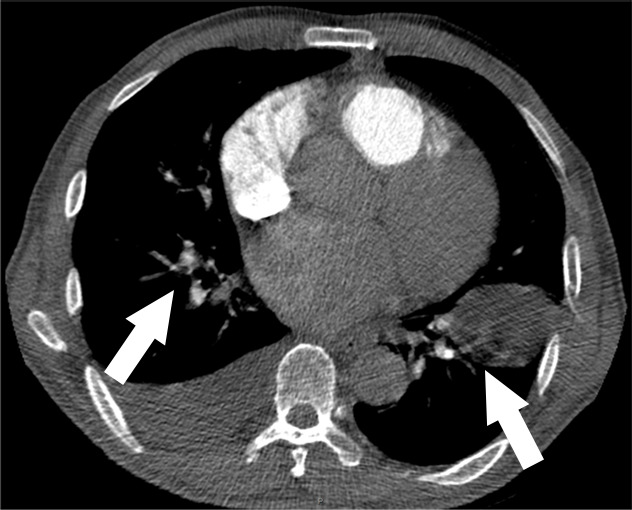 Examples of study- and image-level labels. (a) Central Pulmonary Embolism (PE): saddle embolus within the main, right, and left pulmonary arteries (arrow). (b) Right-sided PE and Left-sided PE: pulmonary emboli within the right interlobar, right lower lobe (arrow), and lingular pulmonary arteries (arrowhead). (c) Chronic PE: nonocclusive intraluminal web within the right lower lobe pulmonary artery (arrow). (d) True Filling Defect not PE: left lung malignancy invading the left main pulmonary artery. (e) Flow Artifact: an apparent filling defect within the left pulmonary artery, which is due to laminar flow of contrast media rather than PE (arrow). (f) RV/LV Ratio: < 1: normal RV (red line) to LV (blue line) ratio. (g) RV/LV Ratio: ≥ 1: evidence of right heart strain characterized by an elevated RV/LV ratio. (h) QA-motion: impaired image quality at the lung bases due to respiratory motion (arrows). (i) QA-contrast: insufficient opacification of the pulmonary arterial tree (arrow) to allow for the assessment of PE. LV = left ventricle, QA = quality assurance RV = right ventricle.