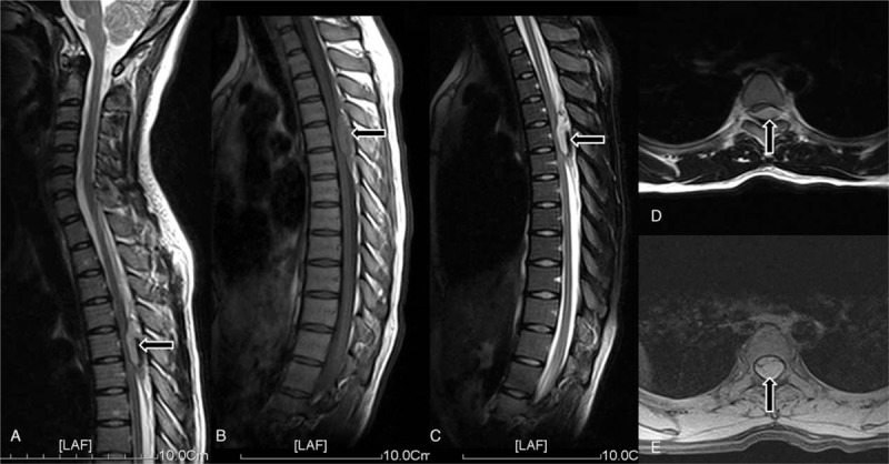 Spontaneous spinal epidural hematomas: One case report and ...