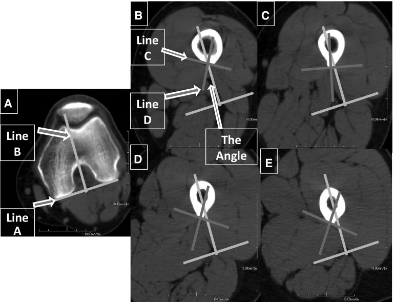 The linea aspera as a guide for femoral rotation after tumor resection ...