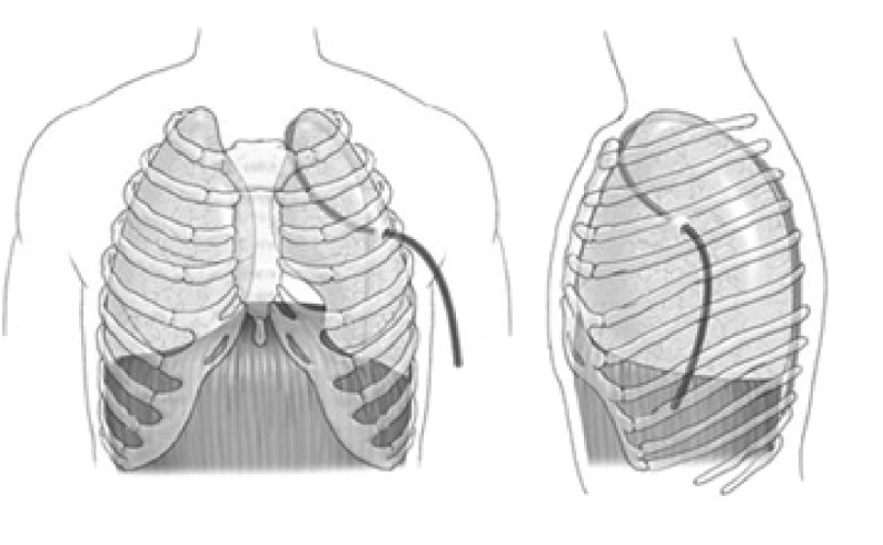 Reproduced with permission from Nakamura H, Taniguchi Y, Miwa K, Adachi Y, Fujioka S, Haruki T. The use of Blake drains following general thoracic surger y: is it an acceptable option? Interact Cardiovasc Thorac Surg. 2009; 8(1): 58-61. http://icvts.ctsnetjournals.org/2009 European Association of Cardio-Thoracic Surgery.