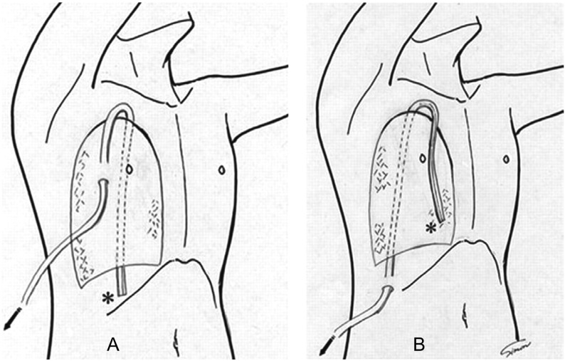 Reproduced with permission from Nakamura H, Taniguchi Y, Miwa K, Adachi Y, Fujioka S, Haruki T. The use of Blake drains following general thoracic surger y: is it an acceptable option? Interact Cardiovasc Thorac Surg. 2009; 8(1): 58-61. http://icvts.ctsnetjournals.org/2009 European Association of Cardio-Thoracic Surgery.