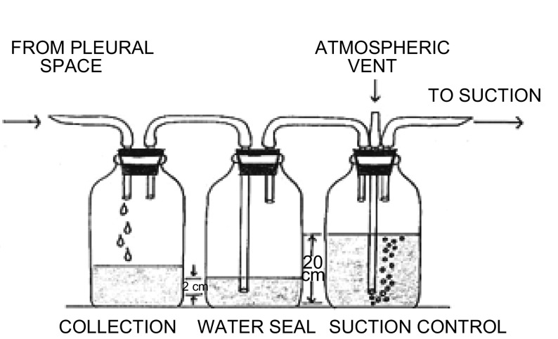 From Howe BE Jr. Evaluation of chest suction with artificial thorax. Surg Forum. 1952; 2: 1-7.