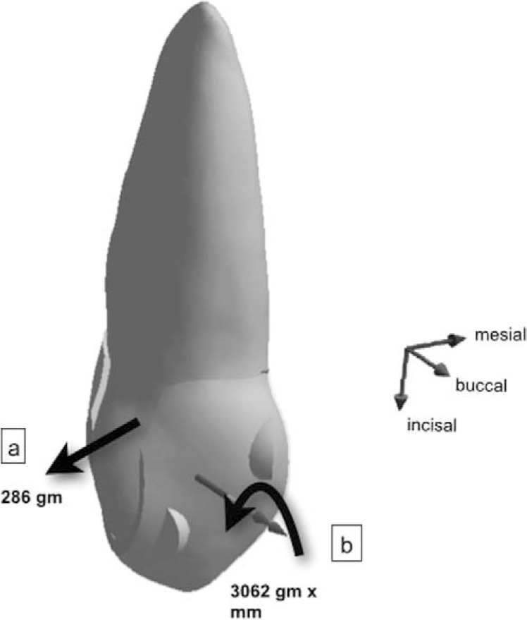 Figure 7. . Resultant force system acting on the tooth; 286 g net force (a) in distal direction, 3062 g × mm net counterclockwise moment (b).