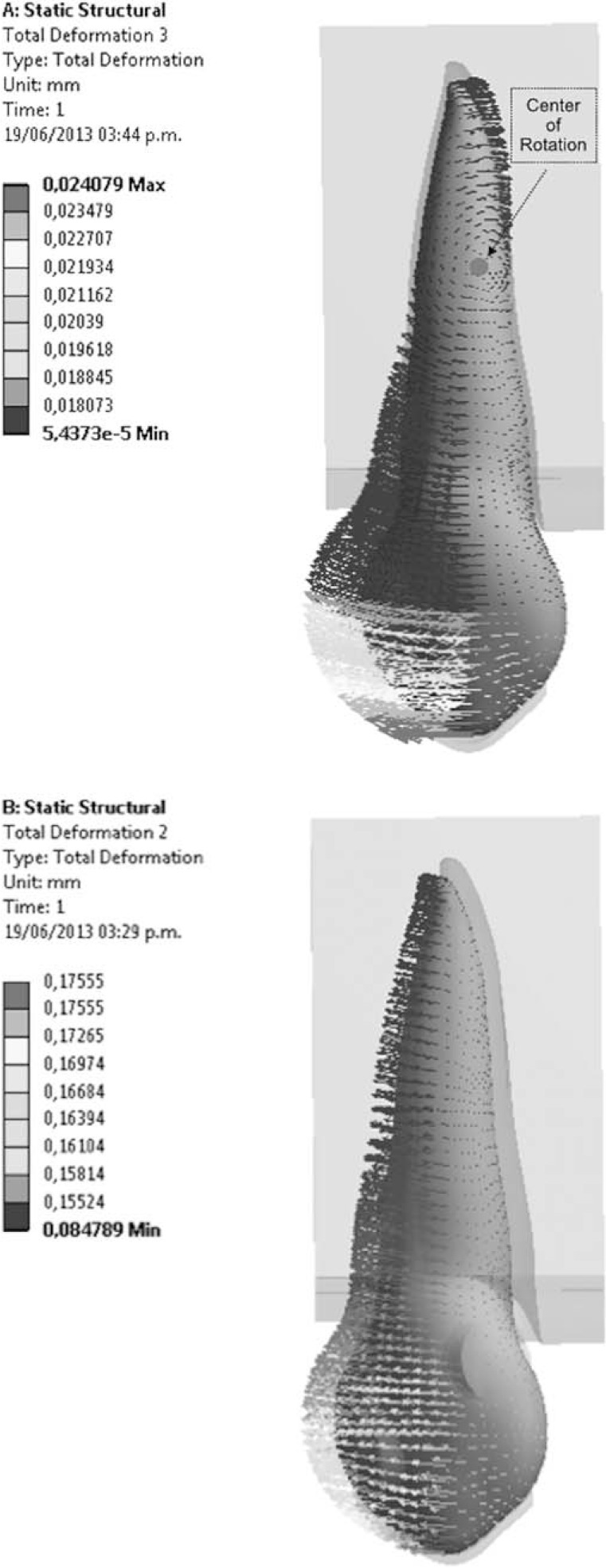 Figure 5. . (a) Displacement patterns at the PDL in a model without composite attachments. (b) Displacement patterns at the PDL in a model without composite attachments.