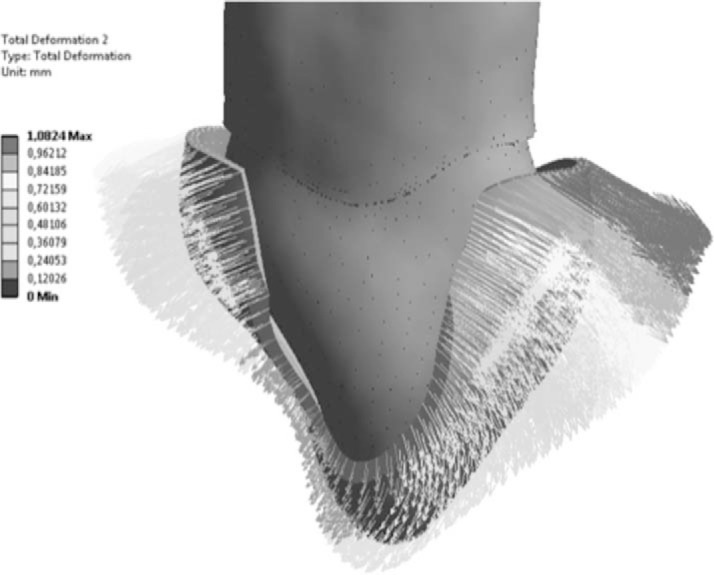 Figure 8. . Bucco-lingual flaring of the aligner segment during distal displacement.