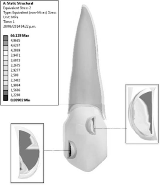 Figure 6. . Equivalent stress patterns produced by aligner on active surfaces of attachments.