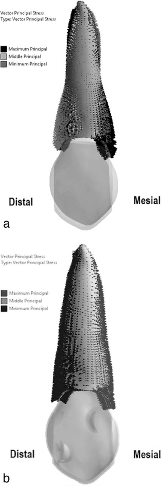 Figure 4. . (a) Tension-compression patterns at PDL, in a model without composite attachments. (b) Tension-compression patterns at PDL, in a model with composite attachments.