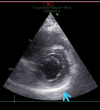 Still image from echocardiogram, short axis