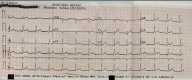An EKG strip showing heart rate of 80 with ST segment elevation