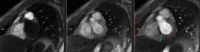 Three still shots from a cardiac MRI