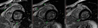 Three still shots from a cardiac MRI