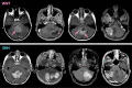 Examples of axial contrast-enhanced T1 MRI scans of wingless (WNT) and
sonic hedgehog (SHH) medulloblastoma. T1-Correlation, a global measure of
homogeneity, was greater for SHH on contrast-enhanced T1-weighted MRI scans.
At a macroscopic level, SHH tumors appear to have more homogeneous
distribution of high signal intensity across pixels on T1-weighted MRI scans
compared with more heterogeneous enhancement of WNT tumors, which might
relate to higher vascular fragility and associated hemorrhagic components.
Note that hemorrhagic fluid-level (*) and stippled and curvilinear
foci of enhancement (arrows) are seen in the patient with WNT
tumor.