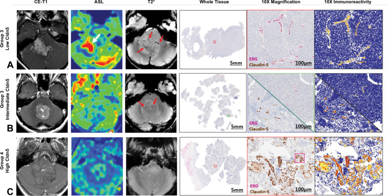 Contrast-enhanced (CE) T1-weighted, arterial spin labeling (ASL), and T2*-weighted MRI features of medulloblastoma and corresponding vascular immunohistochemistry. The ETS-related gene (ERG) antibody (pink) stains are for nuclei of endothelial cells, which line the interior surface of blood vessels and are a marker of vascular density. The Claudin-5 (Cldn5) antibody (brown) stains are for endothelial tight junction protein and mark blood-brain barrier integrity. (A) Images in a patient with group 3 right cerebellopontine mass. On T2*-weighted image, the mass shows heterogeneous enhancement with irregular T2* foci of blood products or deoxyhemoglobin of tumor vascularity (red arrows). Corresponding ASL image shows high perfusion (white arrow). Diffuse loss of Claudin-5 expression (lack of brown staining) along endothelial cells (pink ERG staining) suggests blood-brain barrier breakdown. (B) Images in a different patient with group 3 tumor show faint foci (red arrows) on T2*-weighted image, intermediate perfusion, and heterogeneous distribution of Claudin-5 expression, depending on the tumor specimen location (blue and green boxes). (C) Images in patient with group 4 tumor show mild, patchy enhancement and intermediate perfusion. No discrete blood products are present on T2*-weighted MRI scan. Diffuse Claudin-5 expression is seen associated with abundant endothelial cells (pink staining behind the brown staining) within the tumor, suggesting high vascular density associated with preserved blood-brain barrier integrity.