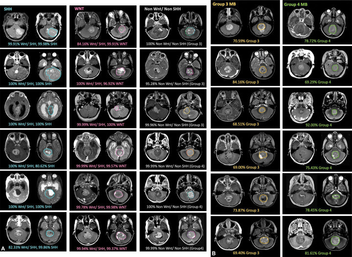 Examples of probability output on contrast-enhanced T1-weighted (left) and T2-weighted (right) MRI scans from the medulloblastoma (MB) test subset that did not participate in the model development. (A) Results of a staged primary classifier model are shown with probability outputs of non-wingless (WNT) and non–sonic hedgehog (SHH) and subsequent outputs of WNT and SHH generated from WNT and SHH. (B) Examples of tumors from an independent binary classifier model that differentiates between group 3 and group 4 are shown.