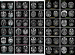 Examples of probability output on contrast-enhanced T1-weighted (left)
and T2-weighted (right) MRI scans from the medulloblastoma (MB) test subset
that did not participate in the model development. (A) Results of a staged
primary classifier model are shown with probability outputs of non-wingless
(WNT) and non–sonic hedgehog (SHH) and subsequent outputs of WNT and
SHH generated from WNT and SHH. (B) Examples of tumors from an independent
binary classifier model that differentiates between group 3 and group 4 are
shown. 