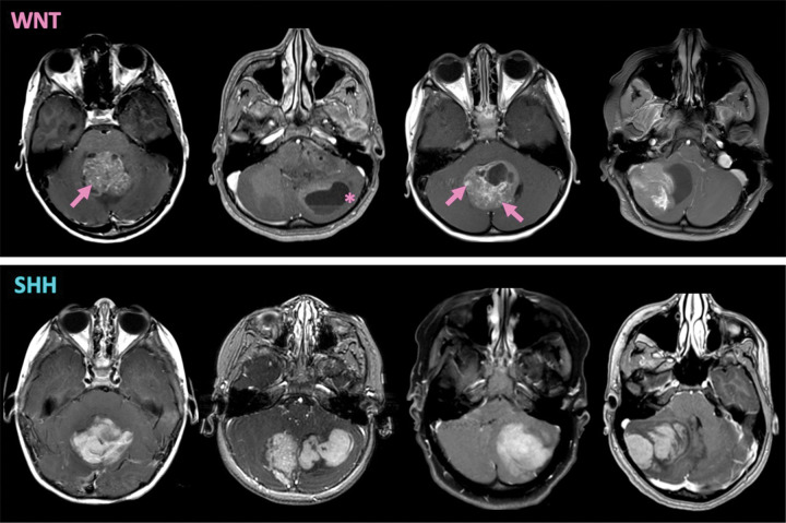 Examples of axial contrast-enhanced T1 MRI scans of wingless (WNT) and sonic hedgehog (SHH) medulloblastoma. T1-Correlation, a global measure of homogeneity, was greater for SHH on contrast-enhanced T1-weighted MRI scans. At a macroscopic level, SHH tumors appear to have more homogeneous distribution of high signal intensity across pixels on T1-weighted MRI scans compared with more heterogeneous enhancement of WNT tumors, which might relate to higher vascular fragility and associated hemorrhagic components. Note that hemorrhagic fluid-level (*) and stippled and curvilinear foci of enhancement (arrows) are seen in the patient with WNT tumor.