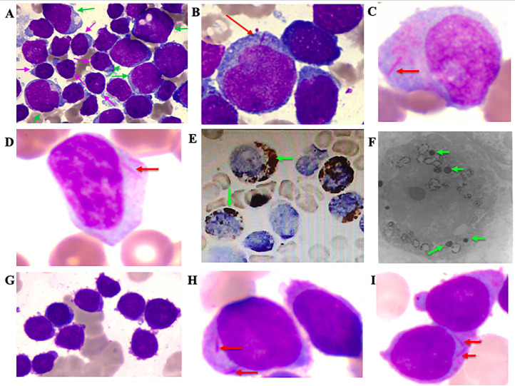 Auer rods in mixed phenotype acute leukemia, T/myeloid: A report of ...