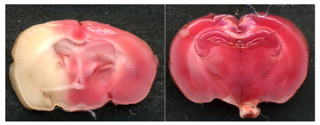 Ischemic infarcts (TTC staining) of brain sections from wild-type mice (left) and mice in which the NOX4 gene has been knocked out (right) 24 hours after a transient occlusion of middle cerebral artery, a model of stroke. Ischemic infarcts (white areas indicating brain damage) are substantially smaller in NOX4 knockout mice and are associated with improved neuronal functions and survival. Image: Christoph Kleinschnitz.