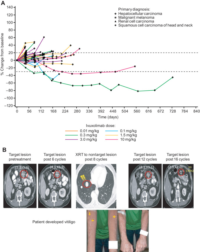 Figure 5. A, Spider plot of tumor size change from baseline over time by dose and tumor type (RECIST). B, Patient receiving ivuxolimab at 10 mg/kg received radiotherapy to a nontarget lesion after 8 cycles and subsequently developed vitiligo. The patient's status was SD after 8 cycles, but by cycle 14 (day 212) of ivuxolimab, the patient achieved a durable PR lasting until cycle 31 (day 462).