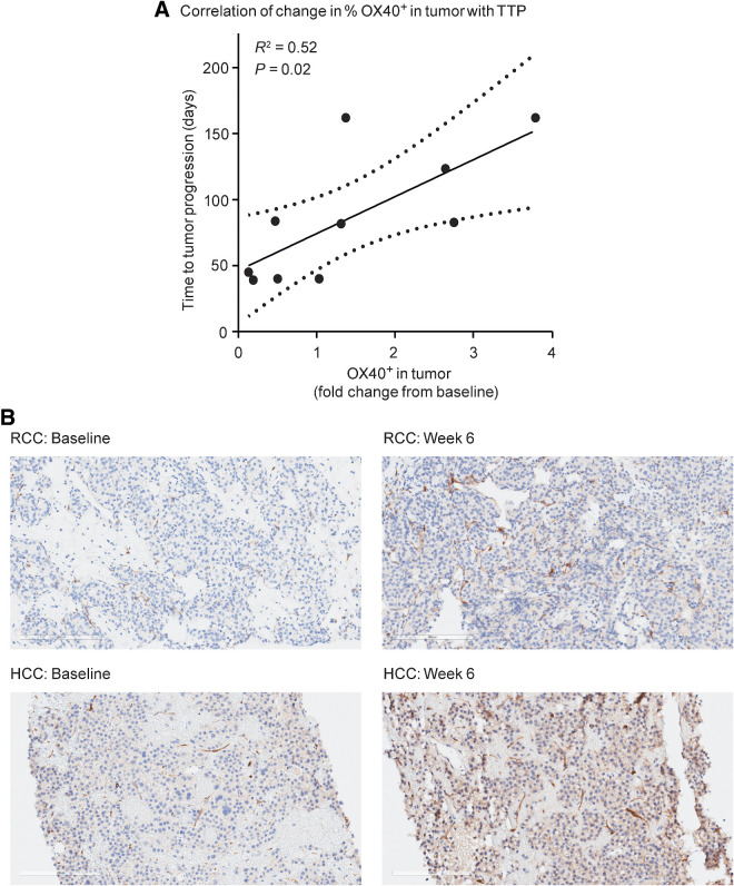 Figure 3. A, A positive correlation between changes in tumor OX40 expression and TTP was observed in a limited sample set. TTP did not exhibit any correlation with baseline or fold-change expression of CD8, CD4, or FoxP3. B, Examples of OX40-positive staining at baseline and week 6 in a patient with RCC and a patient with HCC. 20× magnification. 4-μm sections were stained with anti-CD134 clone ACT-35 murine IgG1 antibody (BD catalog #555836).