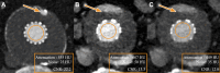 Exemplary images of endoleaks after endovascular repair of an aortic
aneurysm. (A) Single-energy CT angiographic image in a 77-year-old male
patient at 80 kV in the arterial phase shows endoleak type II (arrow). (B,
C) Multi-energy CT angiographic images in a 77-year-old male patient in the
arterial phase demonstrate endoleak type II (arrows) at (B) 40 keV and at
(C) 50 keV. Please note the highest CT attenuation but also the highest
image noise at 40 keV, resulting in lower subjective image quality. Noise is
given as the SD of CT attenuation in the psoas muscle. Orange circular
outline indicates the measured region of interest. CNR = contrast-to-noise
ratio.