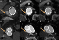 Exemplary images of endoleaks after endovascular repair of an aortic
aneurysm. (A) Single-energy CT angiographic image in an 84-year-old male
patient at 80 kV in the arterial phase shows endoleak type I (arrow). (B, C)
Multi-energy CT angiographic images in a 72-year-old male patient in the
arterial phase demonstrate endoleak type I (arrow) at (B) 40 keV and at (C)
50 keV. (D) Single-energy CT angiographic image at 80 kV in an 80-year-old
male patient in the arterial phase shows endoleak type II (arrow). (E, F)
Multi-energy CT angiographic images in a 75-year-old male patient in the
arterial phase demonstrate endoleak type II (arrow) at (E) 40 keV and at (F)
50 keV.