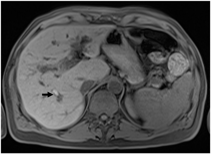 Primary Sclerosing Cholangitis: Diagnostic Criteria - PMC