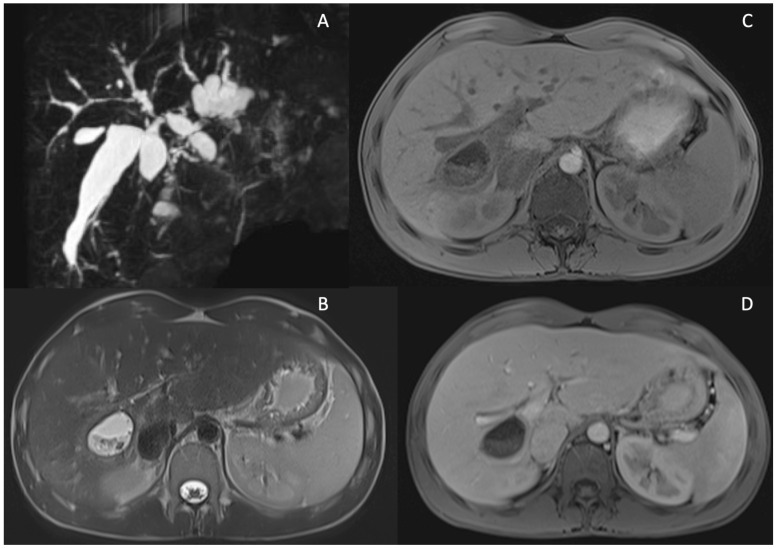 Primary Sclerosing Cholangitis: Diagnostic Criteria - PMC